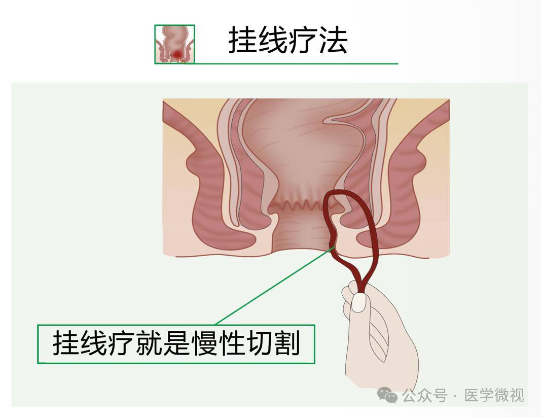 高位肛瘘挂线手术图解图片