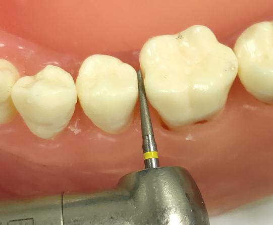 高效,快速——邻面去釉车针_操作_修整_抛光