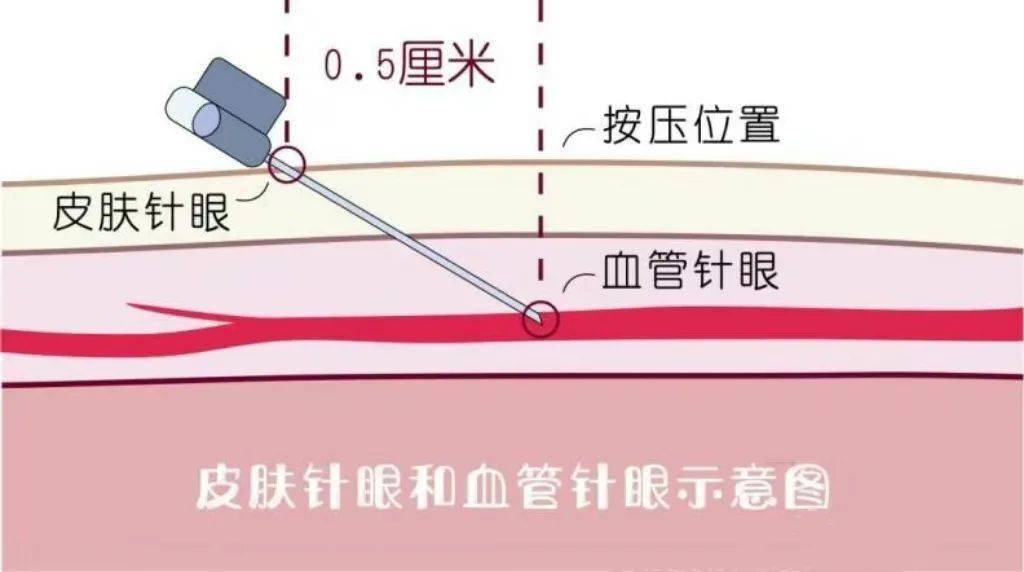 原创科普丨在医院抽血后针眼出现淤青,这是怎么回事?该如何处理?