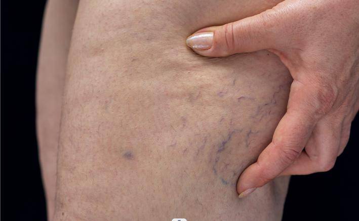 可能比脑梗还要命!_下肢_血管_症状