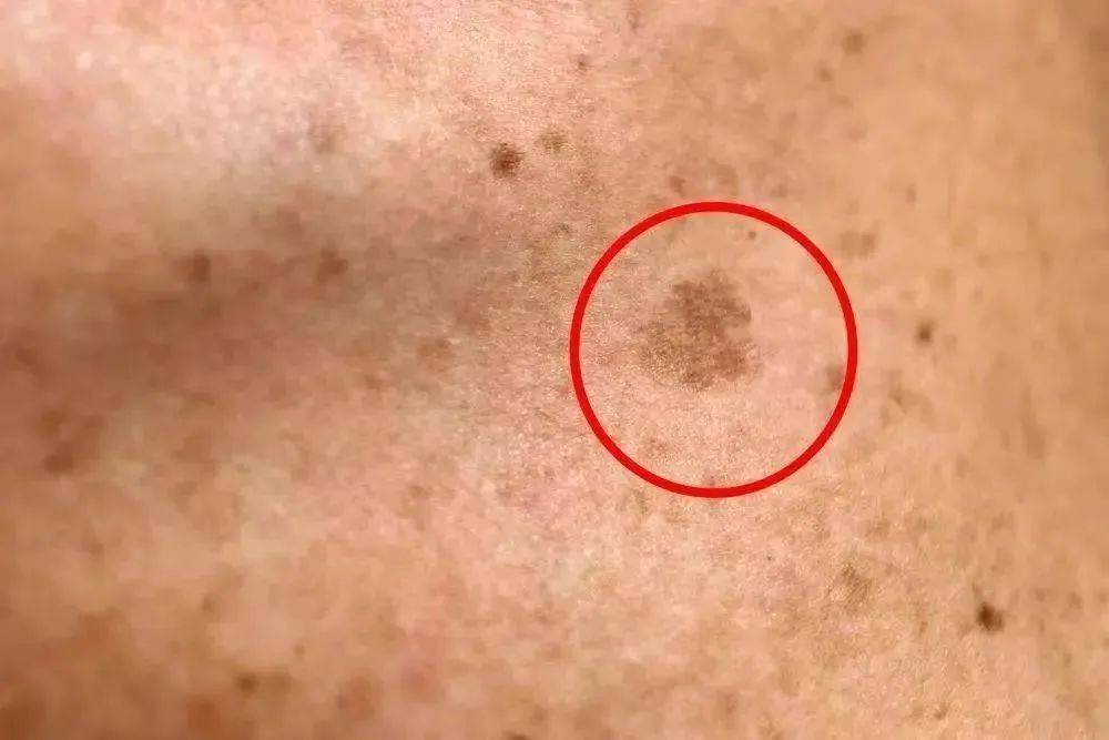 当脸上出现斑点时,皮肤底部可能已经有很多看不见的黑色素正在一点点