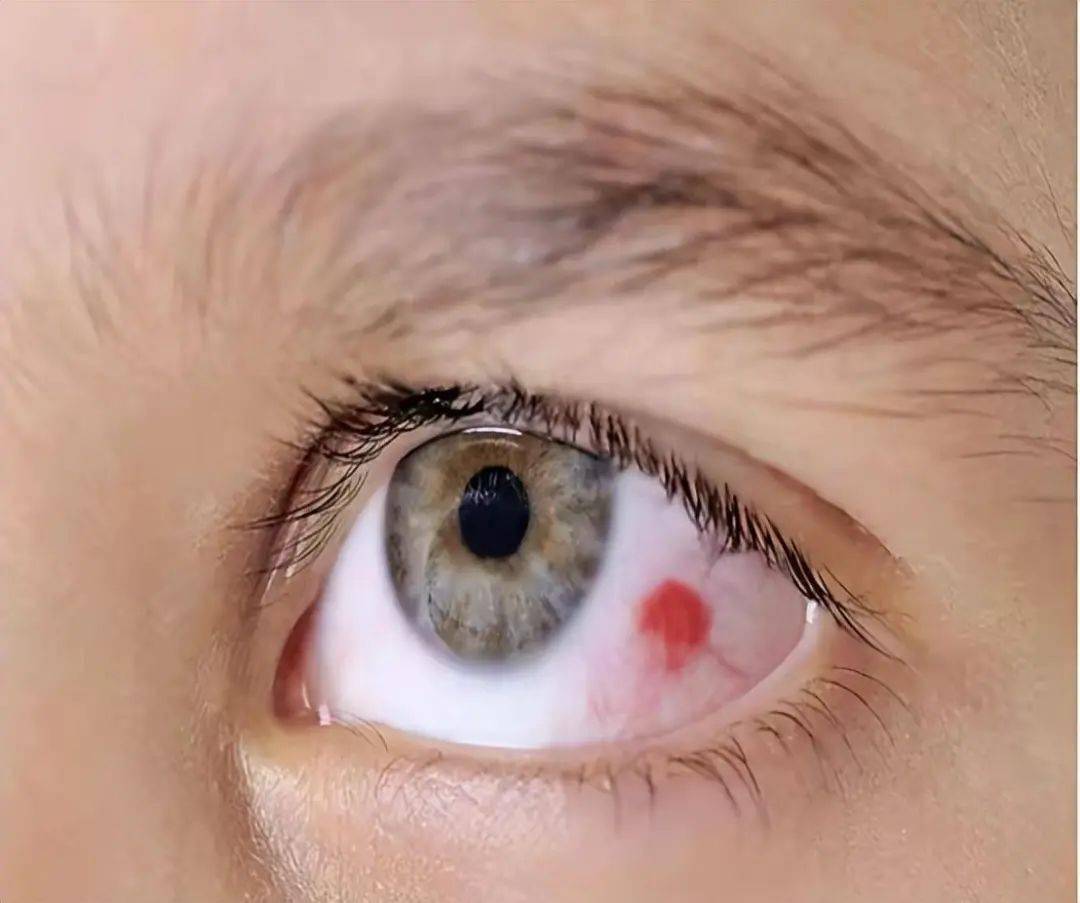 3,眼底损伤高血压对眼底的损伤可以表现为眼底出血,渗出,视乳头水肿