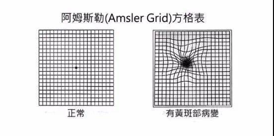 新華醫院眼科治療黃斑裂孔有新招_視網膜_中心_手術