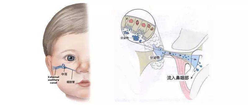 分泌物積存在中耳腔內,形成中耳積液,便