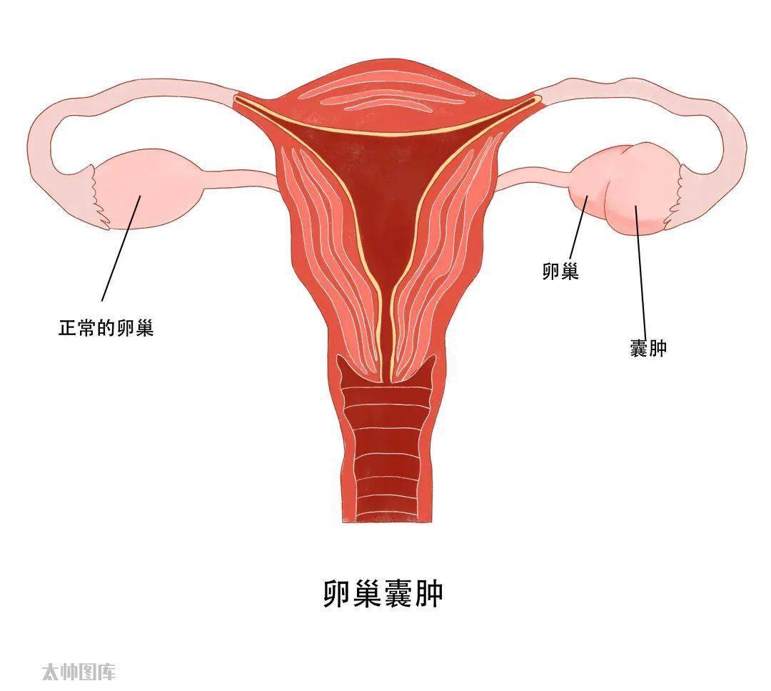 妇科囊肿图片 症状图片