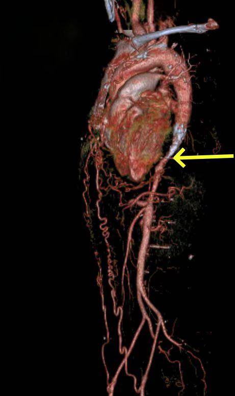 治疗团队发现她的大动脉在胸腹动脉连接段有严重的钙化和缩窄,导致她