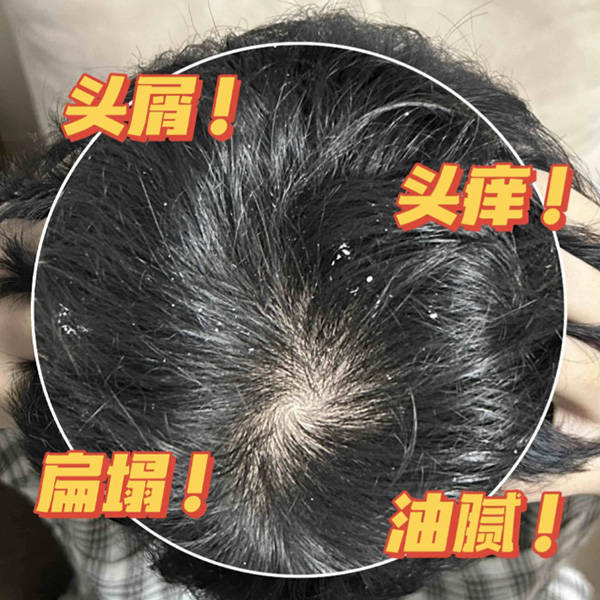 掉大块头皮屑用什么洗发水?