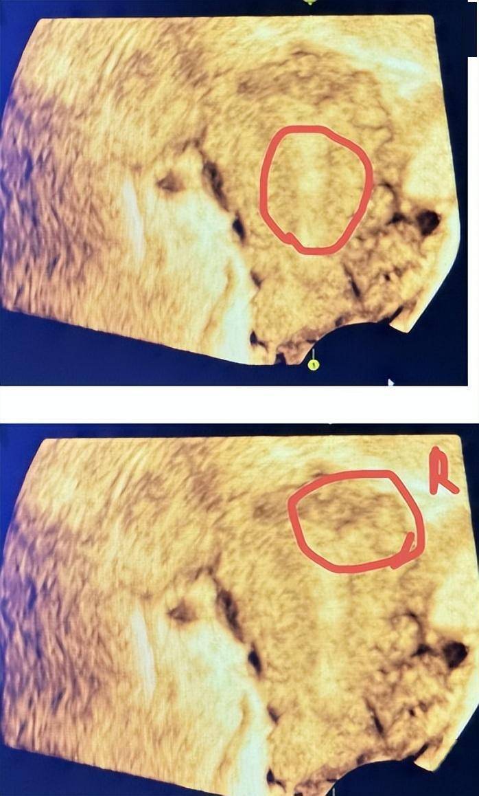 b超提示子宫内膜声像改变,宫腔偏右侧宫角的位置,宫腔中段都有粘连的