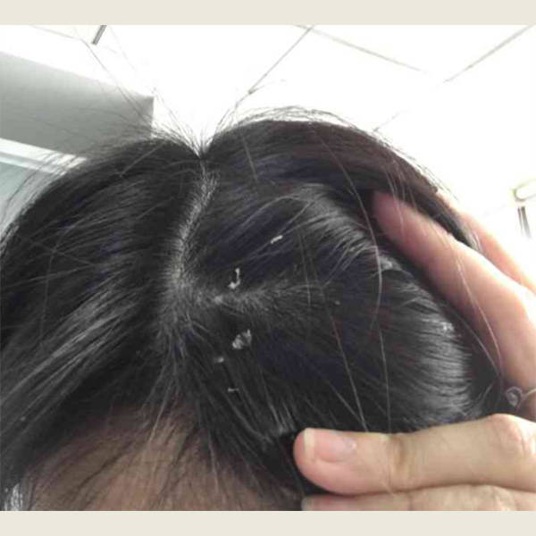 用什么洗发水治头皮痒?国产去屑洗发水排行榜10强_炎症_形象_原因