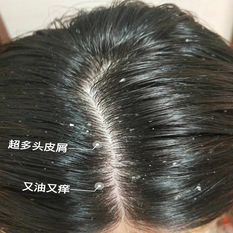 头皮痒什么洗发水好用?洗发水去屑止痒推荐_头发_成分