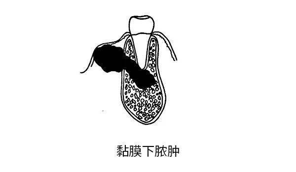 急性根尖周炎各阶段的表现有哪些?_咬合_炎症_牙髓炎