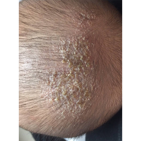 头皮屑是皮脂和角质细胞的混合