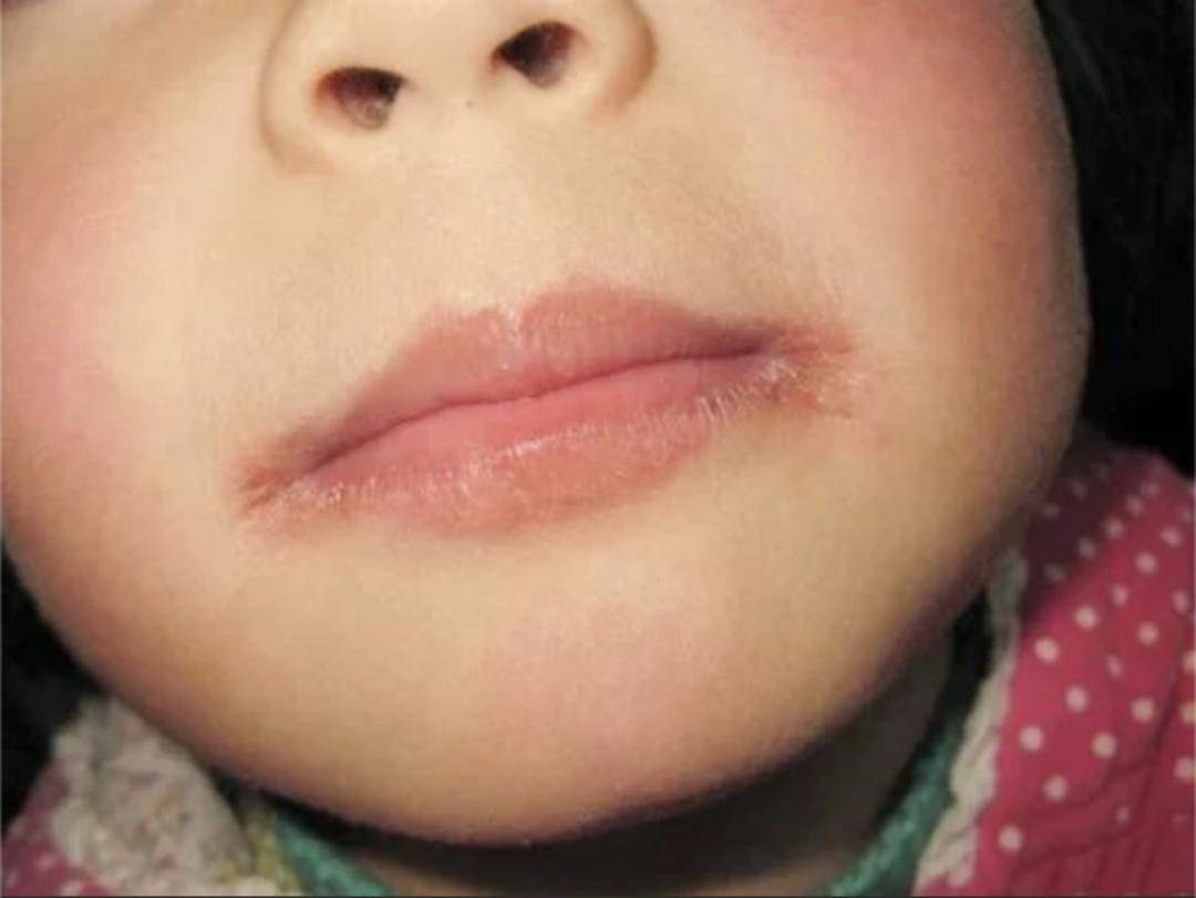 一,望眼角:观察孩子睡觉醒来眼角是否有眼屎出现.观察孩子的"上火"征