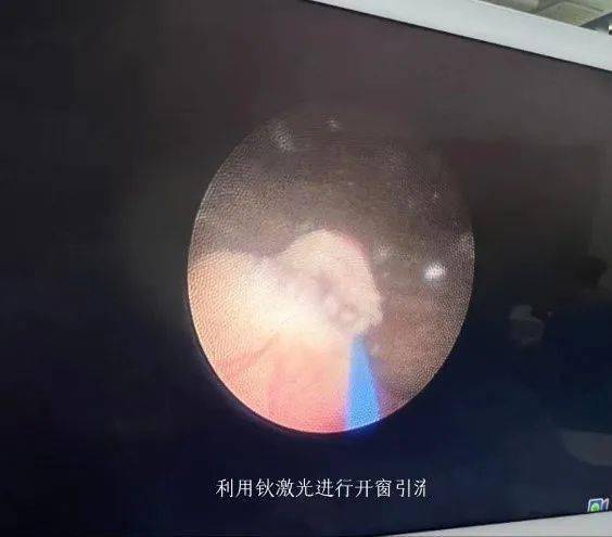 尿路也有"大塞车" ----小儿泌尿系疾病介绍之输尿管囊肿_膀胱_时间