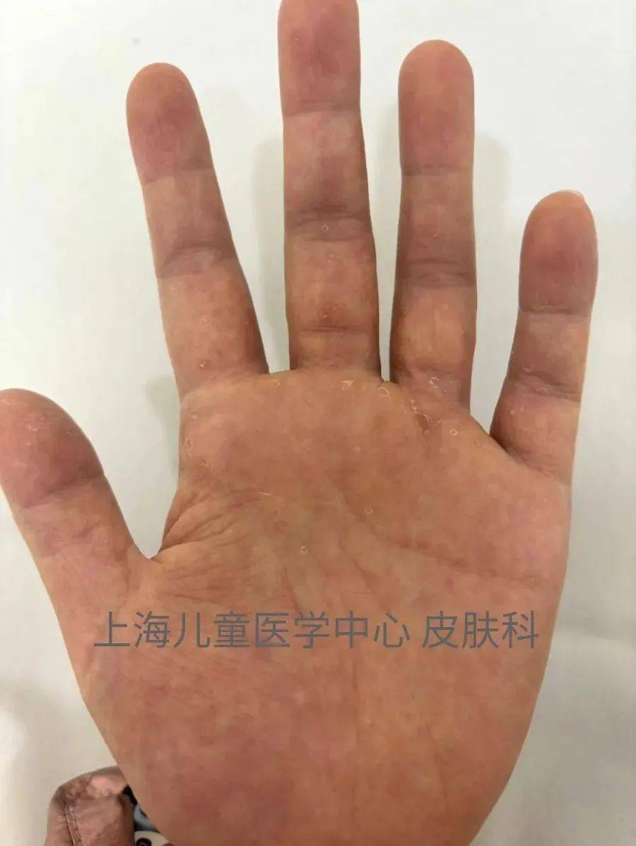 手部_孩子_皮肤