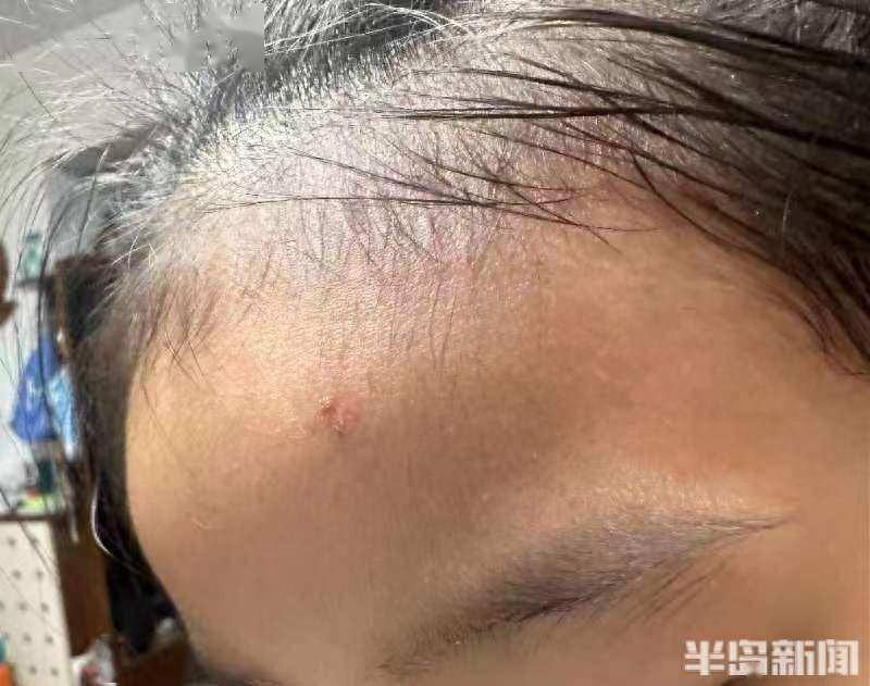 吃烤肉蹦出火星,5岁女童脸上被烫伤_赔偿_处理_女士