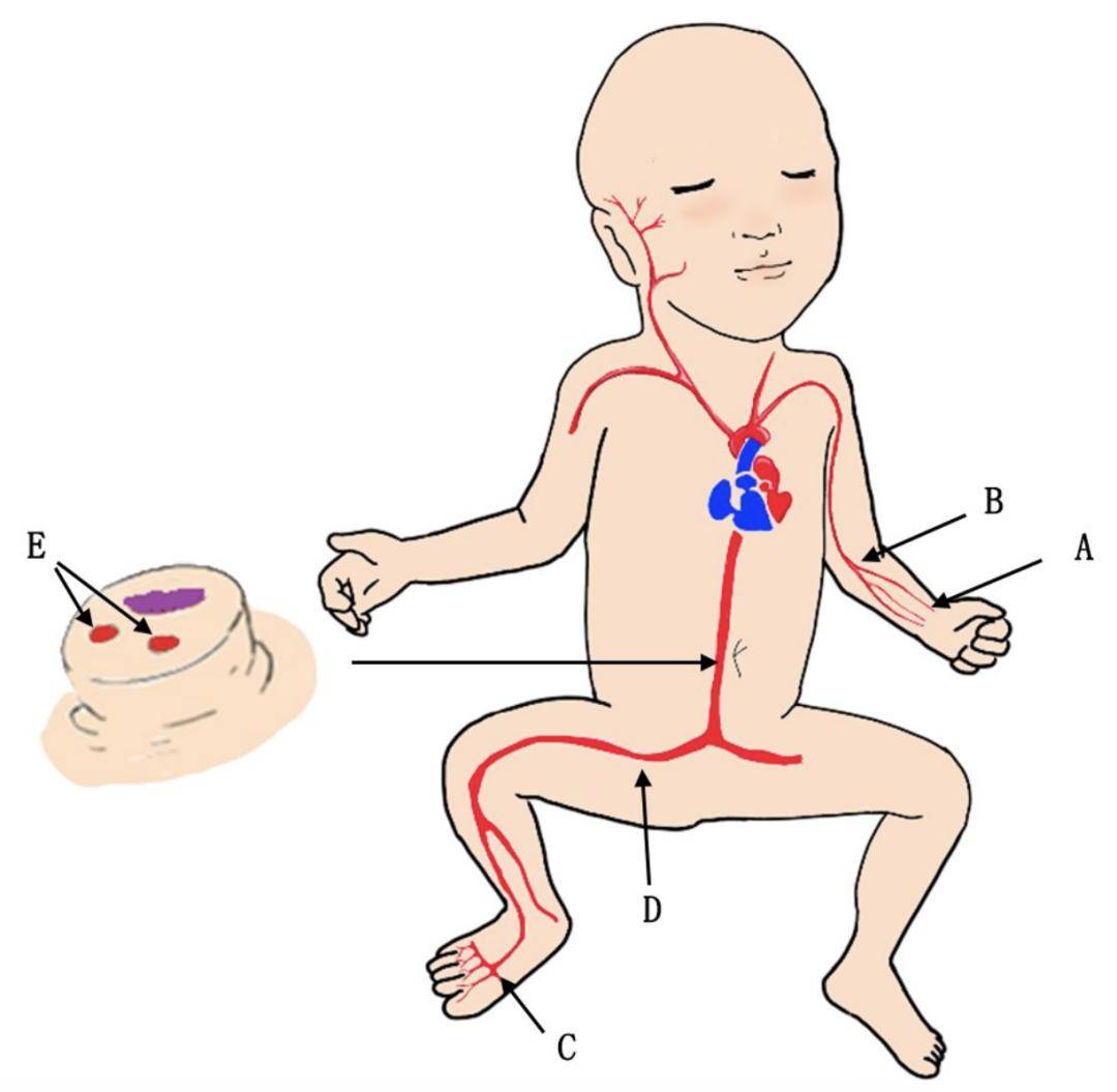 新生儿动脉抽血定位图图片