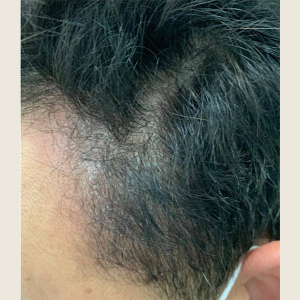 什么牌子洗头膏去屑好?减少头屑的洗发水推荐_头皮屑_头发_效果