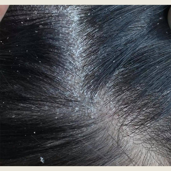 比较好用的去屑止痒洗发水_头皮_问题_炎症