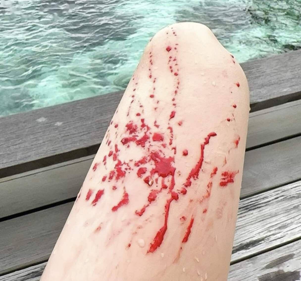 原本雪白大长腿,瞬间开始流血,很有可能会留下疤痕.