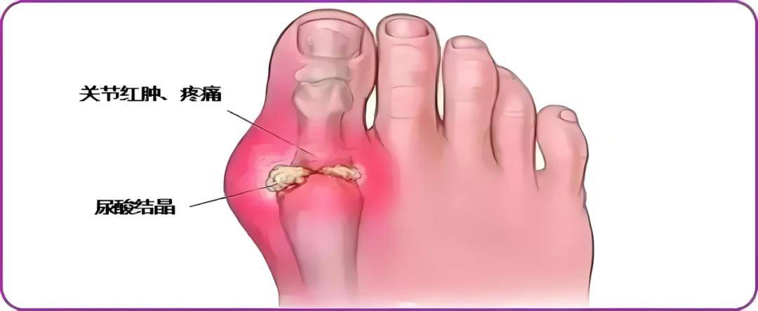 踝关节痛风的位置图图片