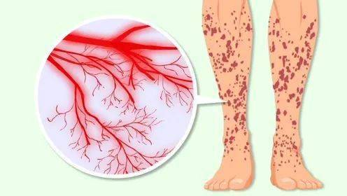 8岁女孩近1年反复流鼻血不止,竟是血液病?_贝贝_血小板_治疗