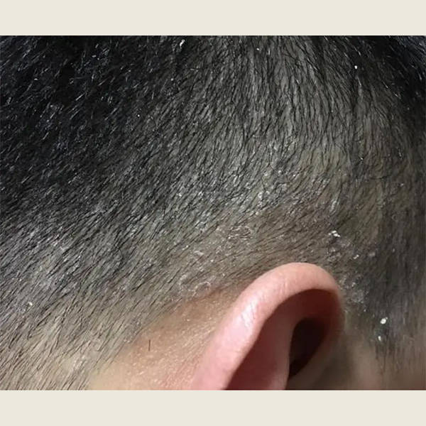 哪个洗发水去屑止痒?洗发水去屑止痒效果排行榜最好_头皮_原因_生理