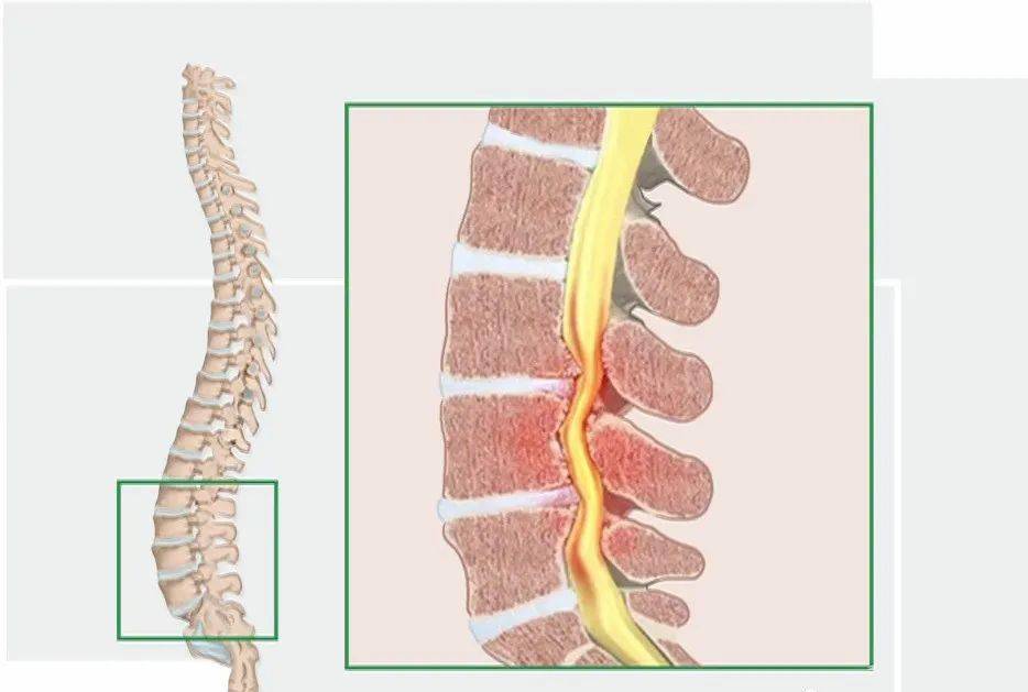 椎管狭窄和椎间孔狭窄的区别