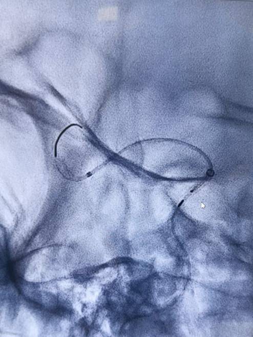 回拉定位后继续释放:支架头端打开:回拉至锚定点,透视及造影下确认