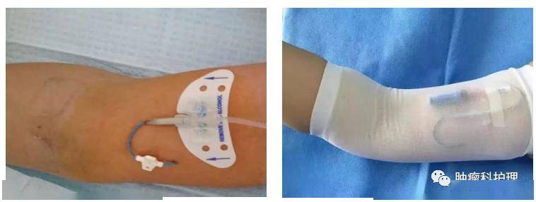 静脉_位置_长度