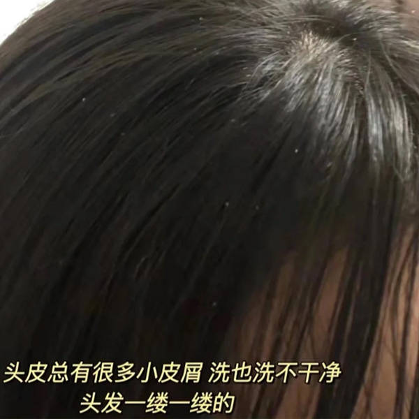 涉及多种因素:头皮屑(脱屑):头皮屑通常是由于头皮的表皮细胞异常脱落