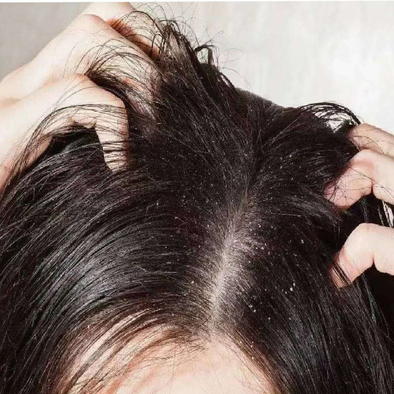 引起,可能受头皮干燥,真菌感染,头皮炎症,过敏反应或过度清洁的影响