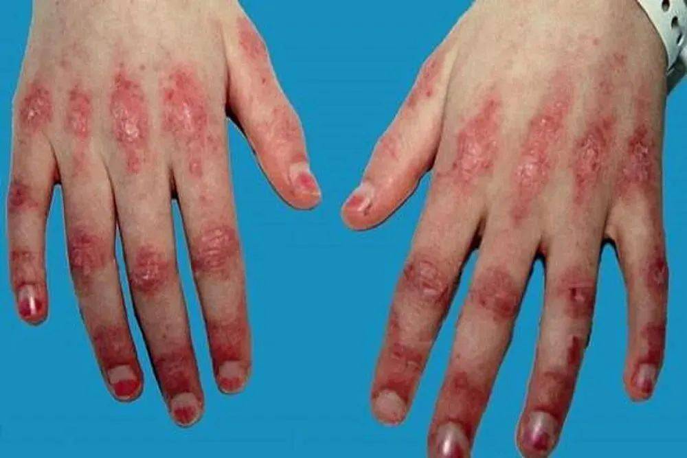 网友:太遗憾_患者_来源_皮肤