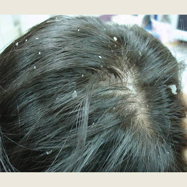 头发_头皮屑_成分