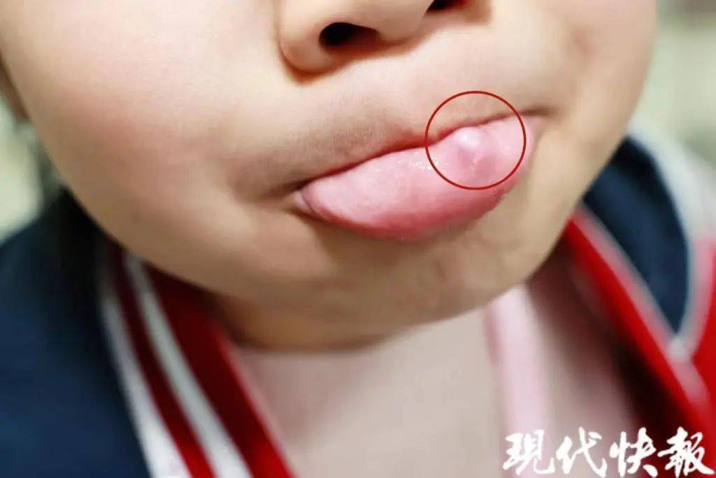 形状圆圆的,发现女儿下唇内侧有个小疙瘩,萱萱的妈妈俞女士查看后