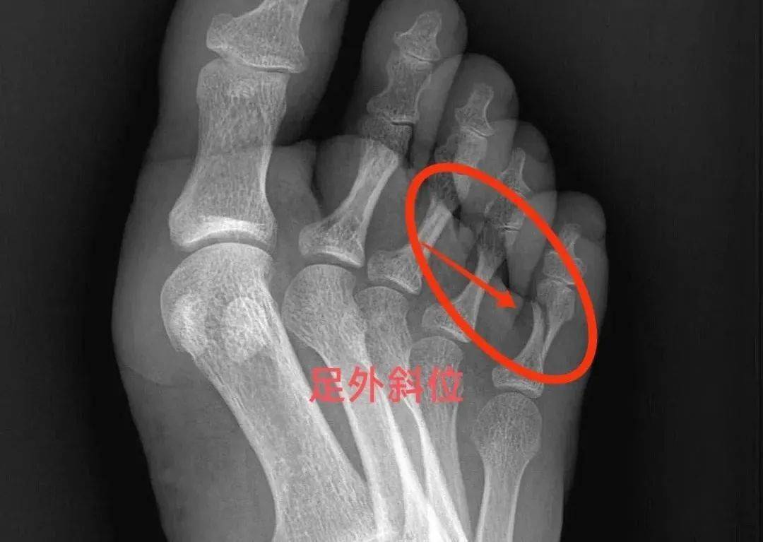 阅片时"马赫带效应"引起的常见误诊_病例_箭头_分界