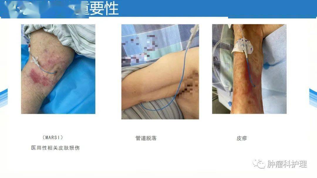 【ppt】经外周静脉置入中心静脉导管(picc)的规范化维护_护理_相关