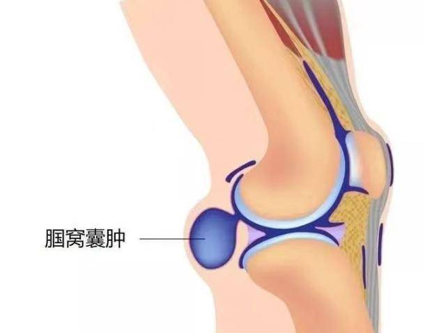 膝盖后面的窝肿的图片图片