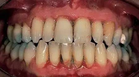 牙龈感染Hpv图图片