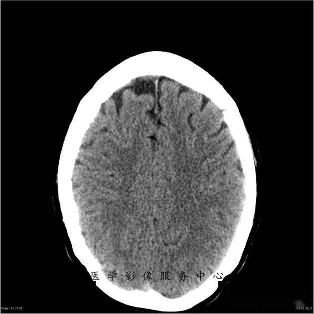 能在这例头颅ct上发现病变的,都是火眼金睛!