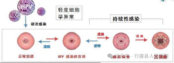 宫颈癌的宫颈图图片