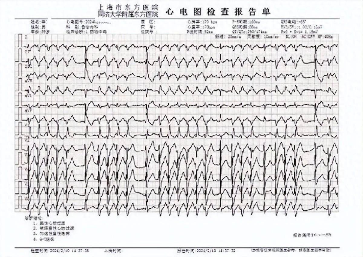 刚被送到东方医院急诊那会儿,李先生情况危急:心电监护显示心率快至