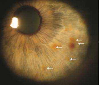lisch结节(虹膜错构瘤):虹膜上的色素沉着,不影响视力