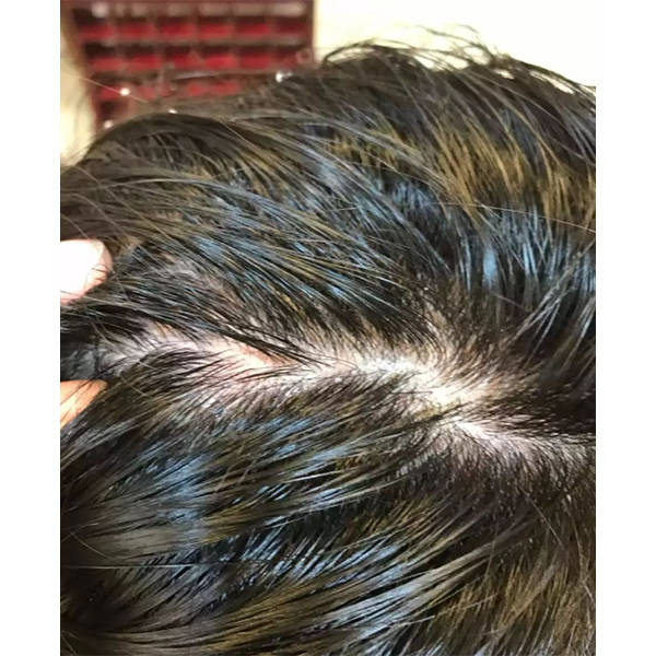 各种头皮问题产生原因:头皮屑通常由以下原因引起:皮脂过多:头皮过度