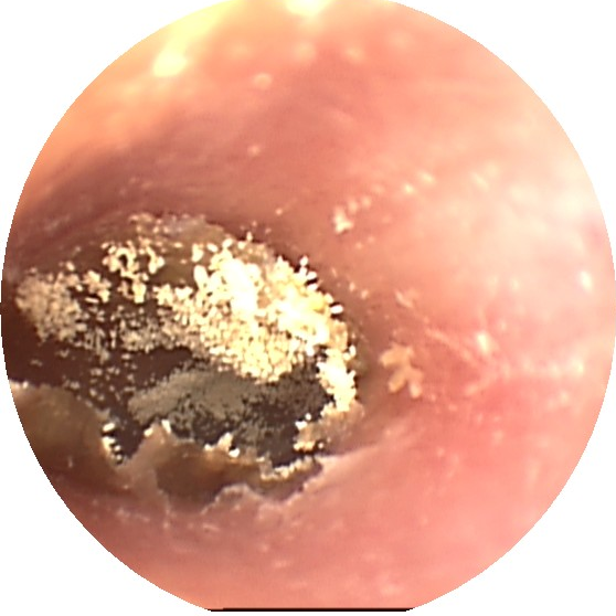 症状和体征多数可有耳痒,耳闷,部分可有耳鸣,听力下降.