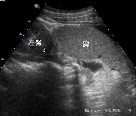 图1 游走脾,脾脏位于左肾下方13岁女孩,右上腹不适星号为左肾下极