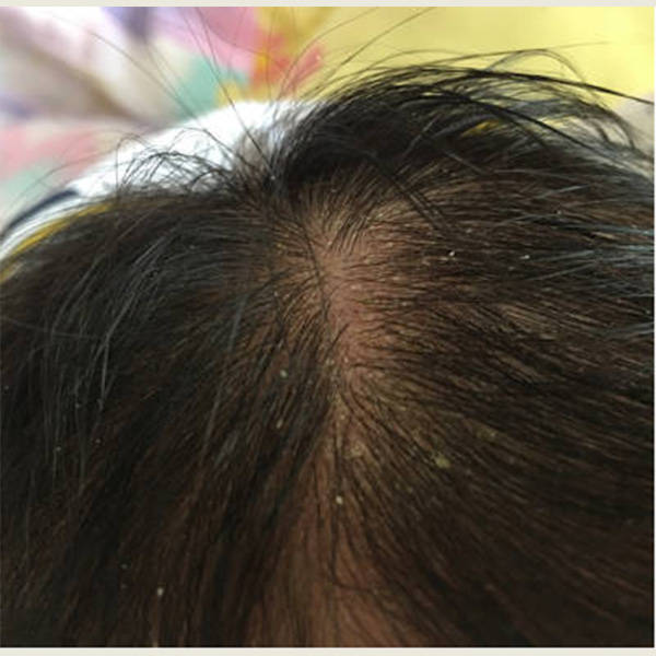 儿童毛囊炎用什么洗发水