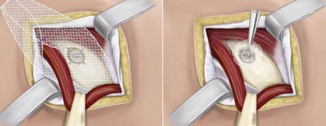 腹股沟疝气手术过程图片