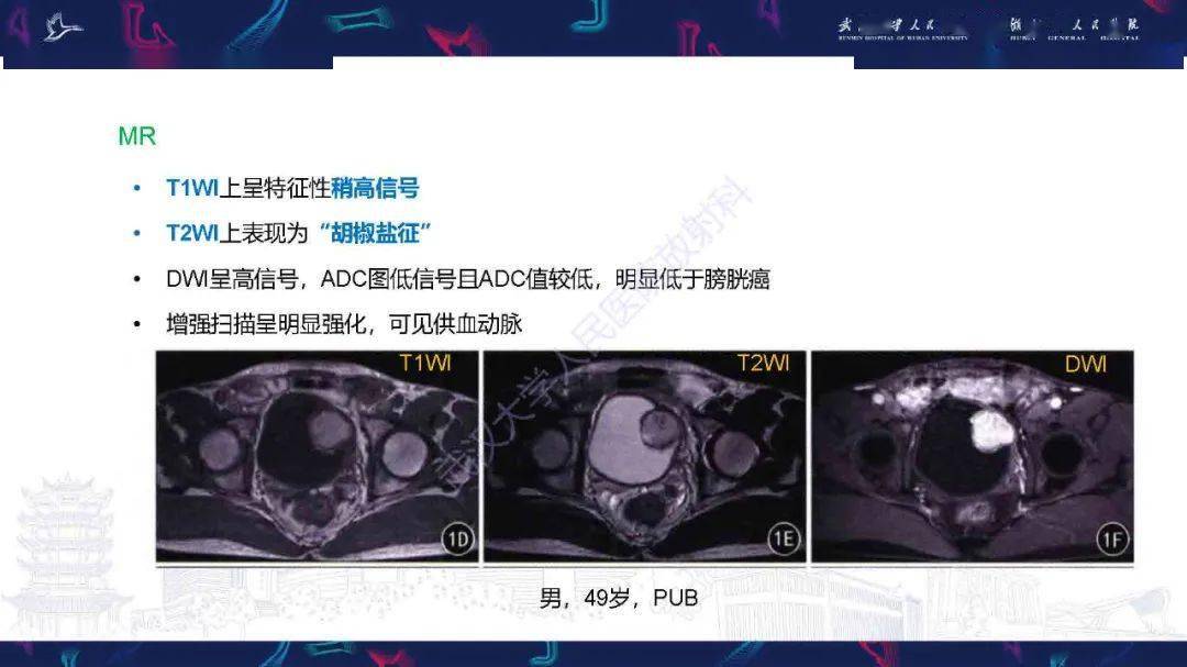 膀胱副神经节瘤影像诊断