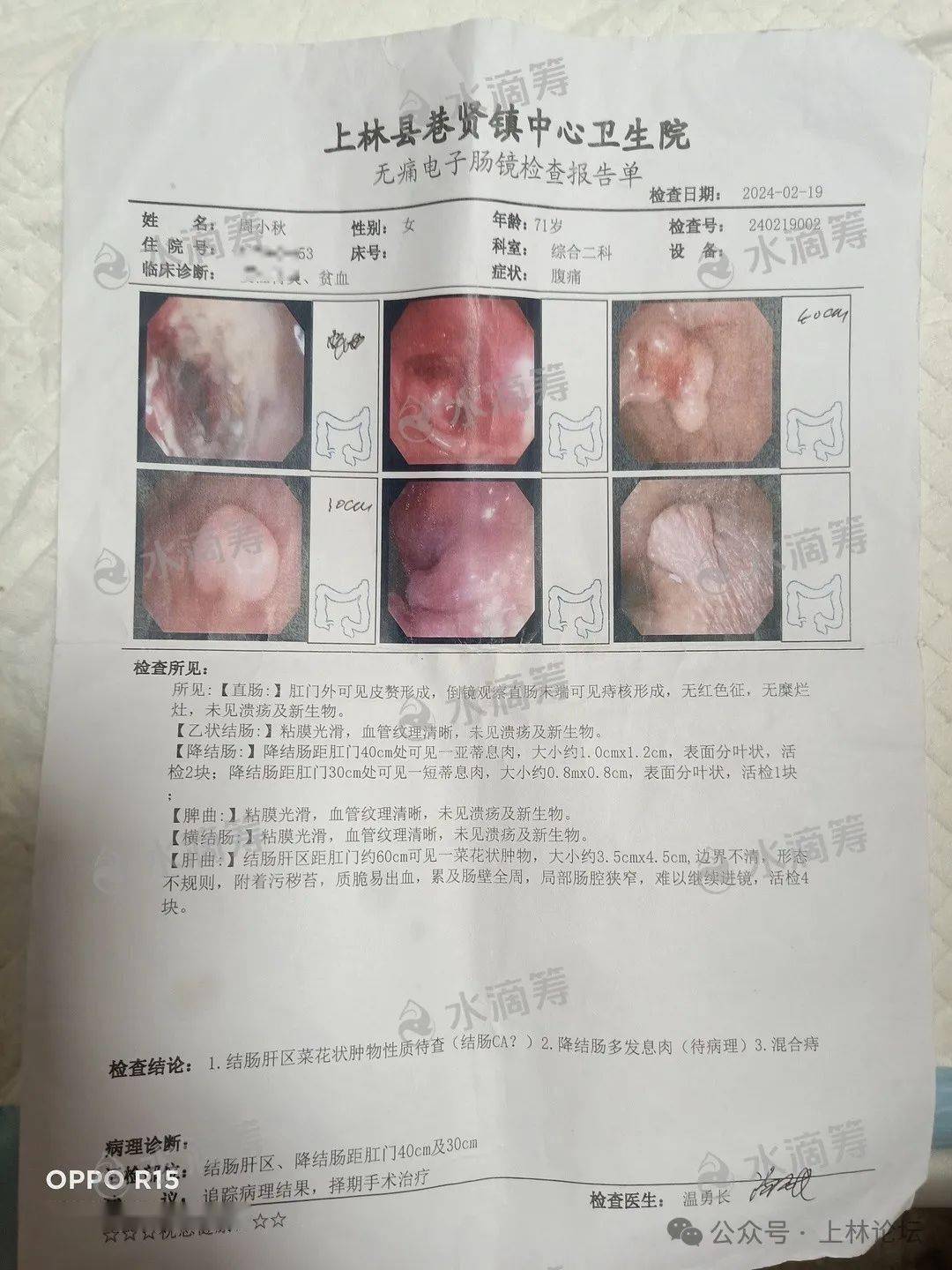 胃炎,贫血,紧急送到镇卫生院输液,输血,做胃镜检查